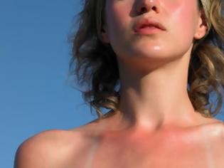 Φωτογραφία για Που οφείλει το δέρμα το χρώμα του και πώς μας προστατεύει από την ηλιακή ακτινοβολία;