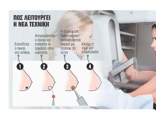 Φωτογραφία για Νέα τεχνική επιτρέπει θεραπεία του καρκίνου του μαστού μόνο με μια ακτινοθεραπεία
