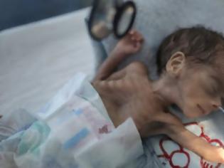 Φωτογραφία για Δράμα στην Υεμένη Σε πρωτόγνωρα επίπεδα οξέος υποσιτισμού εκατομμύρια παιδιά