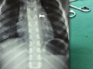 Φωτογραφία για Κρήτη: Τρίχρονη κατάπιε βίδα που κατέληξε στον πνεύμονά της - Δείτε τις σοκαριστικές ακτινογραφίες