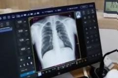 Οι συνέπειες της COVID-19 στους πνεύμονες και σε άλλα όργανα του σώματος που οδηγούν στον θάνατο