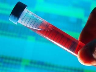 Φωτογραφία για Απλή εξέταση αίματος εντοπίζει δεκάδες τύπους καρκίνου-Blood test for cancer