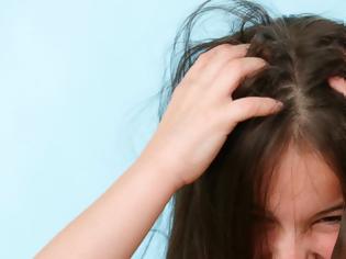 Φωτογραφία για Ψείρες στα μαλλιά του παιδιού: Τι πρέπει να γνωρίζετε για να τις αντιμετωπίσετε