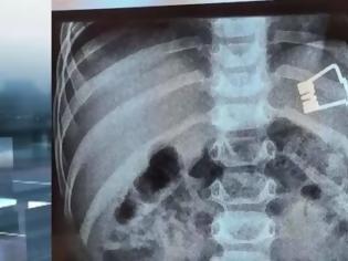 Φωτογραφία για Λήμνος: Αγοράκι 2 ετών κατάπιε μανταλάκι. Οι γιατροί το αφαίρεσαν χωρίς χειρουργείο