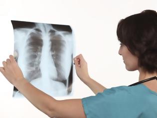 Φωτογραφία για Ανατροπή από νέα ευρήματα: Η φυματίωση μεταδίδεται απλώς με την αναπνοή, όχι μόνο με τον βήχα