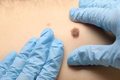 Μελάνωμα: Πότε μια ελιά στο δέρμα είναι «καμπανάκι» για καρκίνο