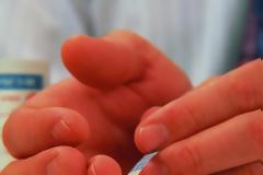 Αναλώσιμα διαβήτη: Δυσχέρειες από την εφαρμογή του νέου συστήματος ταυτοποίησης - συνταγογράφησης