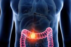 Πληρωμές υποβολών Φεβρουάριου για το πρόγραμμα πρόληψης για τον καρκίνο του παχέος εντέρου