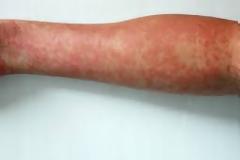 Άρχισαν τα μέτρα τύπου Covid για την ιλαρά στην Αγγλία