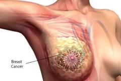 Νέα δεδομένα στη θεραπεία μεταστατικού καρκίνου του μαστού