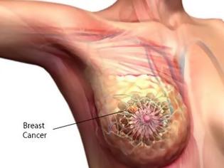 Φωτογραφία για Νέα δεδομένα στη θεραπεία μεταστατικού καρκίνου του μαστού