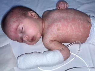 Φωτογραφία για ΕΟΔΥ: Η ιλαρά συνεχίζει να προκαλεί σοβαρές επιπλοκές και θανάτους – 50% των κρουσμάτων στην Ελλάδα είναι ενδημικά