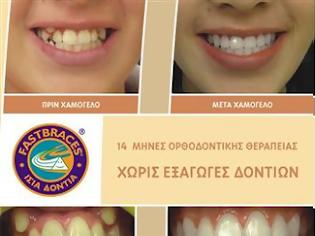 Φωτογραφία για Ίσια δόντια με το σύστημα Fastbraces