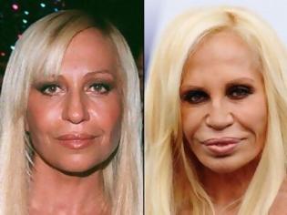 Φωτογραφία για Celebrities πριν και μετά την πλαστική...  [ΦΩΤΟ]