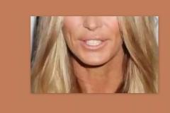 Το αποτυχημένο botox διάσημου μοντέλου!