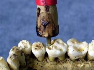Φωτογραφία για Προϊστορικοί οδοντίατροι και σφραγίσματα 6500 ετών