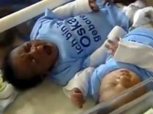 Φωτογραφία για Απίστευτο: Γέννησε δίδυμα αλλά δεν είχαν το ίδιο χρώμα [Video]
