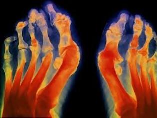 Φωτογραφία για Αρθρίτιδες. Οστεοαρθρίτιδα, ρευματοειδής αρθρίτιδα, ποδάγρα ή ουρική αρθρίτιδα. Τι να κάνετε για να ζείτε καλά με την αρθρίτιδα