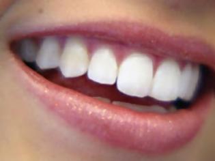 Φωτογραφία για Όλα όσα πρέπει να ξέρετε για την λεύκανση δοντιών