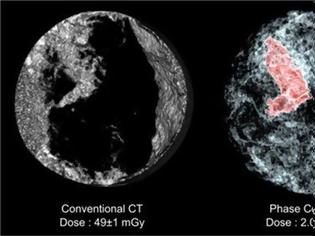 Φωτογραφία για Τομογραφία με καλύτερη ανάλυση και λιγότερη ακτινοβολία,