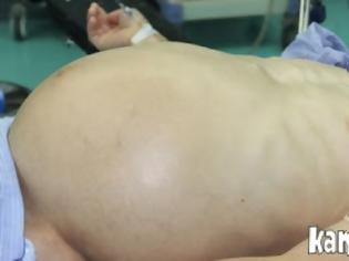 Φωτογραφία για Δείτε τον άντρα που μπήκε στο νοσοκομείο λόγω εγκυμοσύνης!