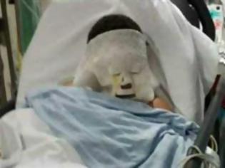 Φωτογραφία για Βεγγαλικό διέλυσε το πρόσωπο 10χρονου