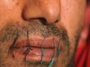 Φωτογραφία για Αφγανός λαθρομετανάστης έραψε το στόμα του... Ζητά την άμεση απέλαση του, αλλά φαίνεται οι αρχές τους κρατάνε εδώ με το ζόρι!!