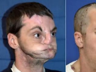 Φωτογραφία για ΑΠΙΣΤΕΥΤΟ: Απέκτησε πρόσωπο μετά από 15 φρικτά χρόνια με μάσκα!