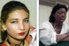 Αυτοκτόνησε πρώην χορεύτρια, θύμα επίθεσης με οξύ