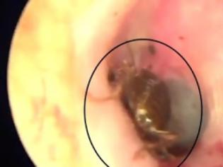 Φωτογραφία για VIDEO | Αηδιαστικό: Κατσαρίδα ζούσε μέσα στο αυτί του!