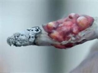 Φωτογραφία για Σοκαριστική αντικαπνιστική καμπάνια - Όγκος αναπτύσσεται σε τσιγάρο