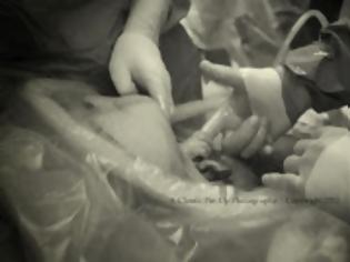Φωτογραφία για Μωρό αρπάζει το δάχτυλο γιατρού τη στιγμή της γέννησης του