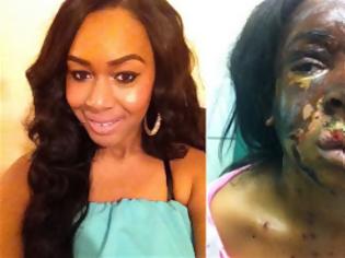 Φωτογραφία για Λονδίνο: 20χρονη υπάλληλος της Victoria Secret's δέχτηκε επίθεση με οξύ στο πρόσωπο