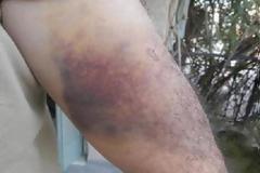 Πάτρα: Tον δάγκωσε ροντβάιλερ  στο πάρκο του Φάρου
