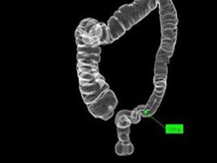 Φωτογραφία για Η κολονοσκόπηση μειώνει τον κίνδυνο προχωρημένου καρκίνου του εντέρου