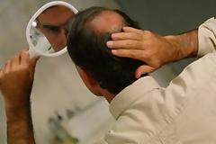 Υγεία: Η ανδρική φαλάκρα ένδειξη αυξημένου κινδύνου για την καρδιά