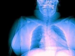 Φωτογραφία για Οι παχύσαρκοι δέχονται περισσότερη ακτινοβολία στις ακτινογραφίες