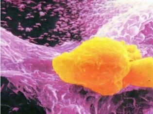 Φωτογραφία για Υγεία: Το γονίδιο της πιο επιθετικής μορφής καρκίνου του προστάτη