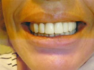 Φωτογραφία για Αραιώνουν τα δόντια σας και παρουσιάζουν κινητικότητα; Μήπως είσαστε περιοδοντικός ασθενείς;