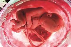 Υγεία: Η λευχαιμία των παιδιών αρχίζει στην εμβρυϊκή ζωή