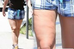 Πασίγνωστη τραγουδίστρια τίγκα στην κυτταρίτιδα