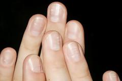 Σε ανησυχoύν τα λευκά σημάδια στα νύχια σου; Δες πραγματικά τι συμβαίνει!