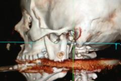 Γυναίκα χτυπήθηκε με ψαροντούφεκο... από τον άντρα της!