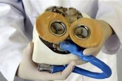 Άδεια εμφύτευσης τεχνητής καρδιάς σε 4 χώρες πήρε η Carmat