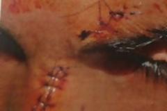 Eικόνες σοκ - Ρατσιστική επίθεση σε ανήλικο Αφγανό στην Αθήνα - Του χαράκωσαν το πρόσωπο