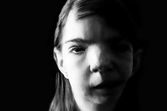 «Είσαι ένα φρικιό» φώναζαν τα άλλα παιδιά -Η συγκινητική ιστορία του κοριτσιού «τέρας»