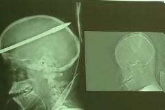 Κρητικός νευροχειρούργος στο βιβλίο Γκίνες για σπάνια επέμβαση