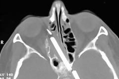 Ζούσε με μολύβι δέκα εκατοστών στο κεφάλι του για 15 χρόνια!