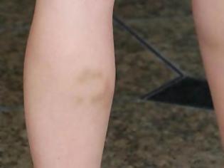 Φωτογραφία για Πασίγνωστη ηθοποιός εμφανίστηκε με δαγκωματιά στο πόδι!