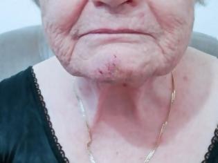 Φωτογραφία για Φρίκη στο Αγρίνιο: Ποντίκια επιτέθηκαν σε ηλικιωμένη μέσα στο σπίτι της - Tην δάγκωσαν στο πρόσωπο και στο χέρι
